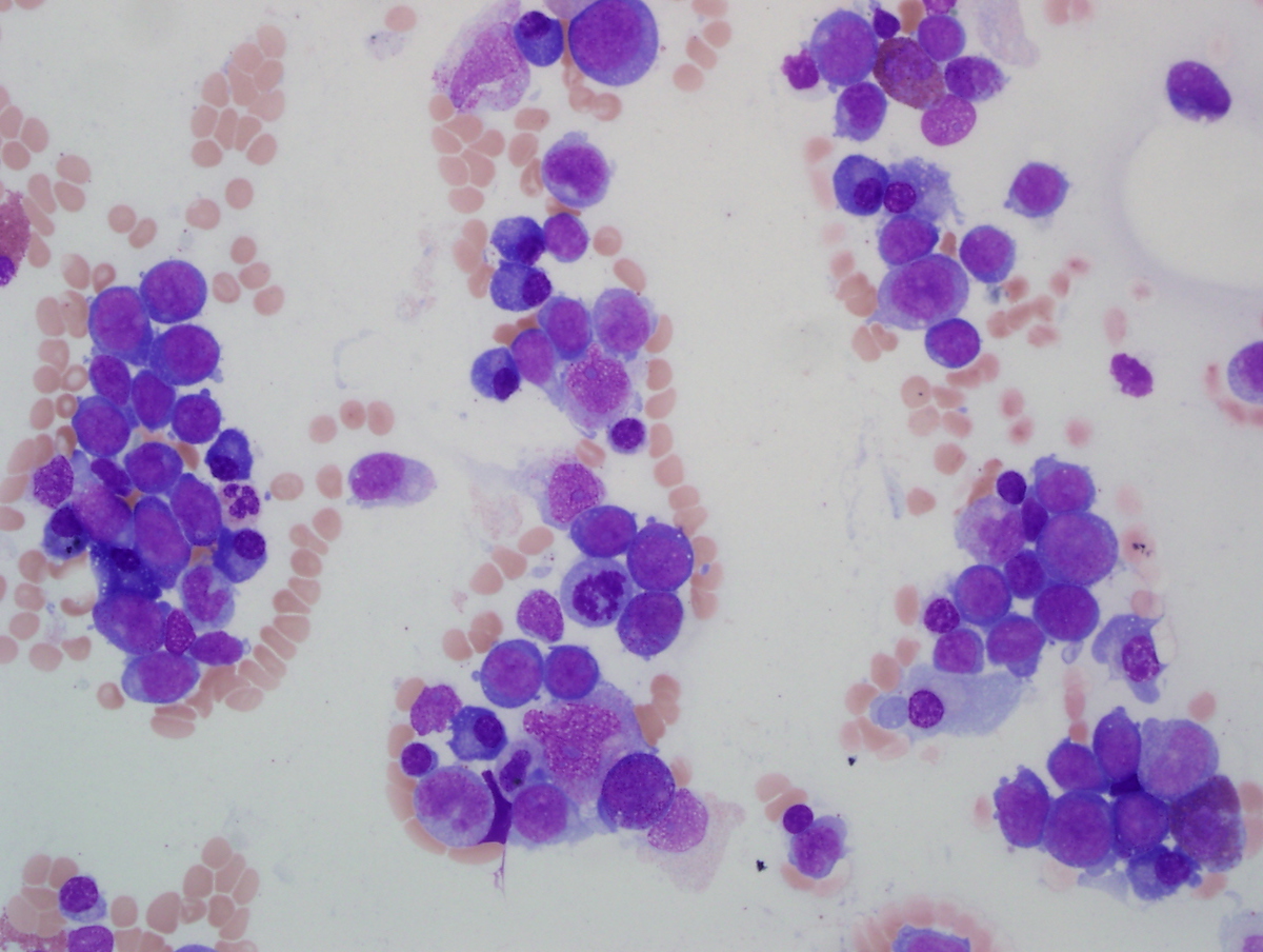 Bone marrow Aspirate July 2012